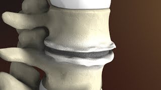 Low Back Pain  Disc Herniation  Everything You Need To Know  Dr Nabil Ebraheim [upl. by Derek217]