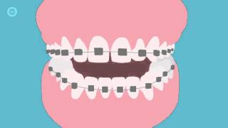 How To Brush Your Teeth With Braces  A Step By Step Guide [upl. by Singhal560]