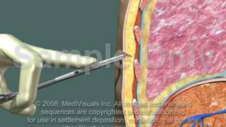 Thoracotomy  Normal Procedure [upl. by Marb613]