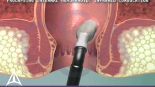 Infrared Coagulation Therapy for Hemorrhoids  3D Medical Animation [upl. by Wilhide]