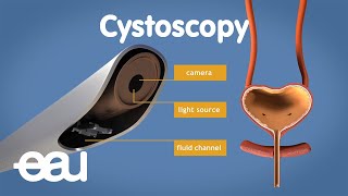 Cystoscopy overactive bladder [upl. by Eelyr]