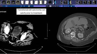 CT Urogram [upl. by Arytal]