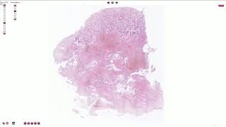 Choriocarcinoma  Histopathology [upl. by Dorren]