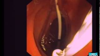 OvertheWire Stent Exchange Using a Simple Snare Technique in ERCP [upl. by Dnomra440]