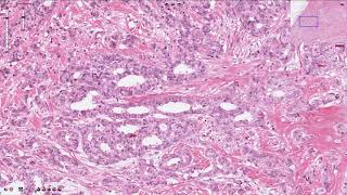 Ductal Carcinoma  Breast [upl. by Alak]