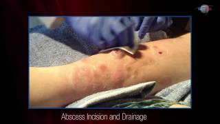 WCW Abscess Incision and Drainage [upl. by Ogilvy791]