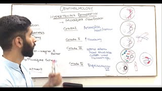 OPHTHALMOLOGY  HYPERTENSIVE RETINOPATHY [upl. by Fanchon]