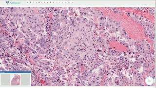 Medullary Carcinoma  Thyroid Gland Histopathology [upl. by Zacks]