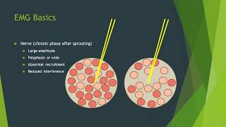 Neuropathy vs myopathy on EMG [upl. by Bigg]