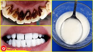 HOW TO REMOVE DENTAL PLAQUE IN 5 MINUTES NATURALLY WITHOUT GOING TO THE DENTIST [upl. by Ahsirtap]