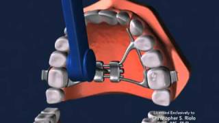 Seattle Orthodontist Dr Christopher Riolo Banded Expander RPE [upl. by Kara]