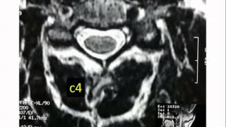 Introduction to CT Cspine Approach and Essentials [upl. by Ecidnarb]