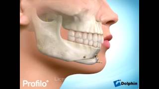 Chin Augmentation Surgery Genioplasty [upl. by Halsy]