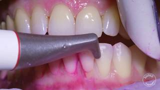 How teeth should be cleaned at the Dentist  Hygienist [upl. by Doolittle]