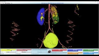 Cystoscopy and placement of guidewire [upl. by Enaujed402]