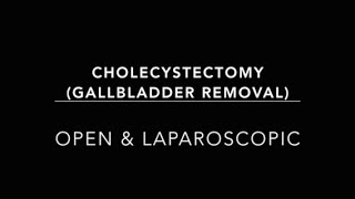 Laparoscopic Cholecystectomy Gallbladder Removal [upl. by Hardigg]