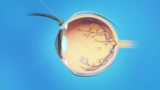 Macular Hole Vitrectomy Surgery [upl. by Kerrie281]