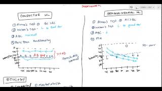 Conductive and Sensorineural Hearing Loss Deafness for USMLE [upl. by Rhona847]