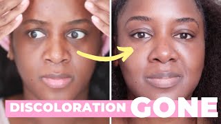 How I Got Rid of My Dark Circles Black Skin [upl. by Dorey345]