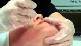 Dermapen Micro Needling Treatment [upl. by Maggie697]