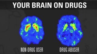 How addiction changes your brain [upl. by Baryram]