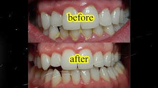 How To Remove Plaque In 5 Minutes  Clean Dirty Teeth At Home Very Fast [upl. by Nosreh]