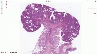 Stages of Colon Cancer [upl. by Dnaltiak]