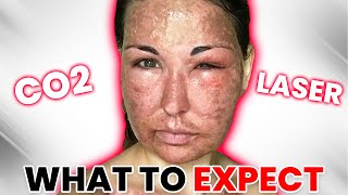 I SURVIVED 3 Fractional CO2 Laser Treatments [upl. by Ecnarwal]