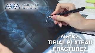 AOA Orthopedic Specialists  Tibial Plateau Fracture [upl. by Ravilob]