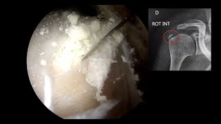 EPAULE N°3  Calcification [upl. by Fredel]