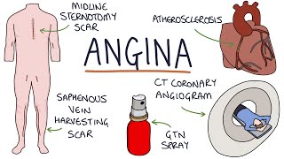 Understanding Angina Visual Explanation for Students [upl. by Maisie]