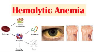 Hemolytic Anemia [upl. by Enoob]