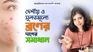 দেশীয় ও সুলভমূল্যে ব্রণের দাগের সমাধান [upl. by Crin]