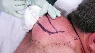 Lénorme boule de Paul  Docteur Pimple Popper [upl. by Warwick]