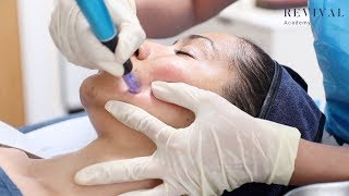 Microneedling Full Training Video [upl. by Chiquita]