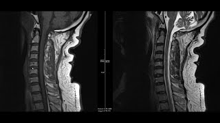 Mechanism of Occipitoposterior Labour  Long Rotation [upl. by Cirillo]