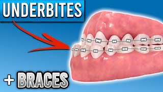 How Do Braces Fix Underbites  Premier Orthodontics [upl. by Vardon380]