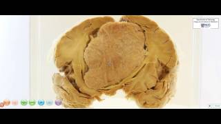 Brain  Meningioma [upl. by Ovatsug]