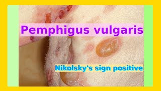 pemphigus vulgaris [upl. by Littlejohn680]