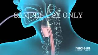 Upper Gastrointestinal Endoscopy EGD [upl. by Crelin]