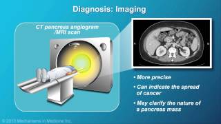 Acute Pancreatitis Chronic Pancreatitis Psuedocyst Adenocarcinoma [upl. by Harolda]