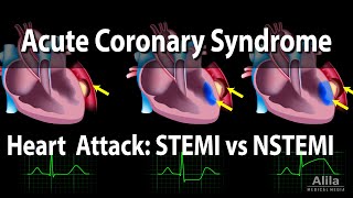 Acute Coronary Syndrome Unstable Angina NSTEMI and STEMI Heart Attack Animation [upl. by Rramed184]