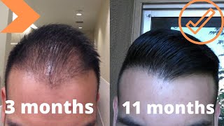 When To Expect Growth After A Hair Transplant My Timeline [upl. by Sanchez194]