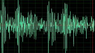 Aortic Regurgitation slow [upl. by Auos]