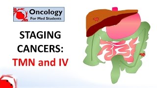 Staging cancers TNM and IIV systems [upl. by Liborio157]