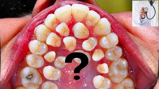 MORE THAN 500 TEETH I Hyperdontia I Gardner syndrome supernumerary teeth ISabaceous Cysts [upl. by Ybrad]