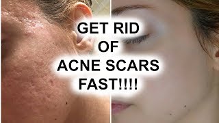 HOW TO GET RID OF ACNE SCARS  Pershii [upl. by Novaelc]