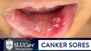 Determining Causes amp Treatment for Canker Sores  SLUCare Otolaryngology [upl. by Naihtniroc]