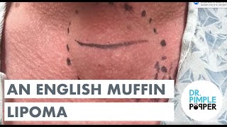 A Life Destroying Bump  Dr Pimple Popper [upl. by Rysler]