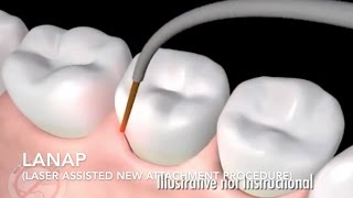 How Does Laser Surgery Work Treat Gum Disease  LANAP [upl. by Heppman600]